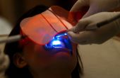 Dents de laser blanchissant en moins d’une heure