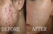 Comment faire pour effacer les marques de l’acné | Cicatrices sombres | Taches de bouton, obtenez une peau de visage propre