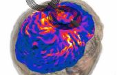 Des Images de résonance au champ électrique : modélisation de la Stimulation magnétique transcrânienne