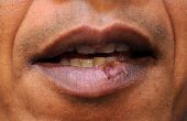 Comment faire pour se débarrasser d’herpès labial dans la bouche