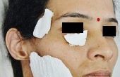 Quantification de défaut des tissus mous du visage pour Fat transférer à l’aide de Scanner 3D et logiciels de reconstruction 3D: une nouvelle approche Non invasive